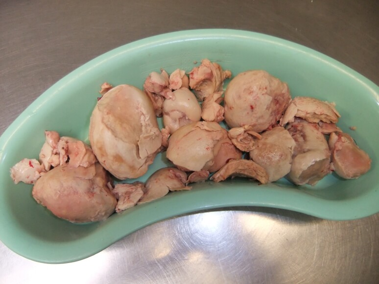 Egg yolk peritonitis  - removed